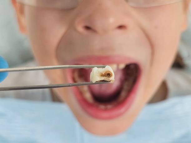 Best Emergency Dentist for Lost Fillings or Crowns in Adel, IA
