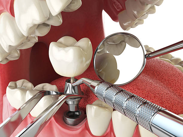 Best Broken or Cracked Tooth Emergency Dentist in Adel, IA
